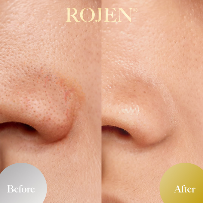 父の日のプレゼントにも🤍
🤩Men's Before and After🤩
https://rojen.jp/tag/mens/
✨️✨️✨️✨️✨️✨️✨️
魔法のひと滴
塗るサプリ🌹
美整オイル®
ROJEN公式サイト
🇯🇵日本
rojen.jp
スキンケアご購入ダイレクトページ
https://rojen.jp/bisei-oil/shop/
🇺🇸USA
rojenusa.com
ROJEN Organic Skincare
https://rojenusa.com/biseioil/
#ROJEN #ロジェン #biseioil #美整オイル #オーガニック #スキンケア #美肌 #紫外線対策 #紫外線 #シミ対策 #シワ対策 #乾燥肌対策 #免疫力強化 #弾力ある肌に変身